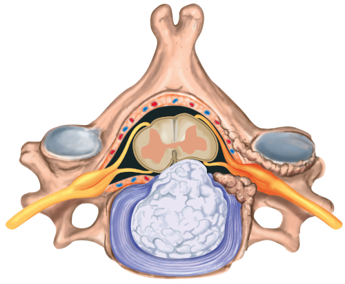 Hernie discale cervicale (cervico-brachialgie) - Centre du dos Genève