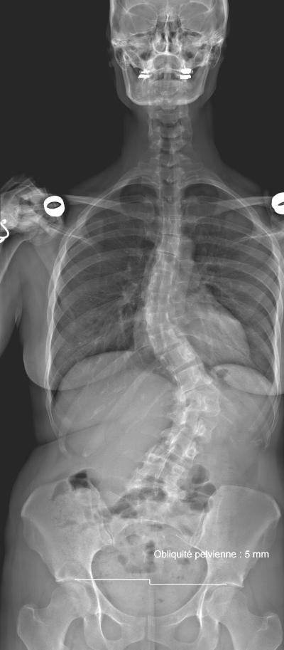 Scoliose Centre Du Dos Gen ve